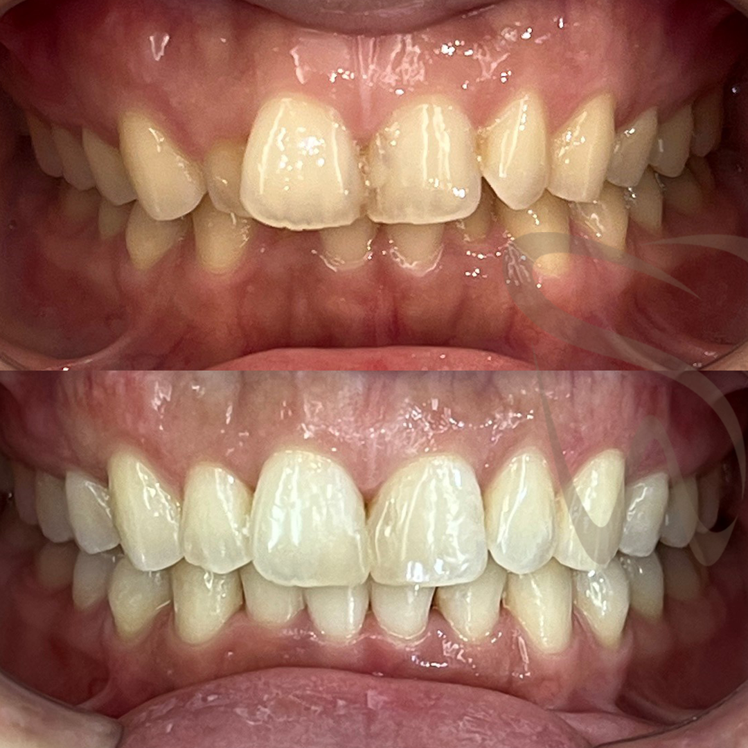 invisalign before after