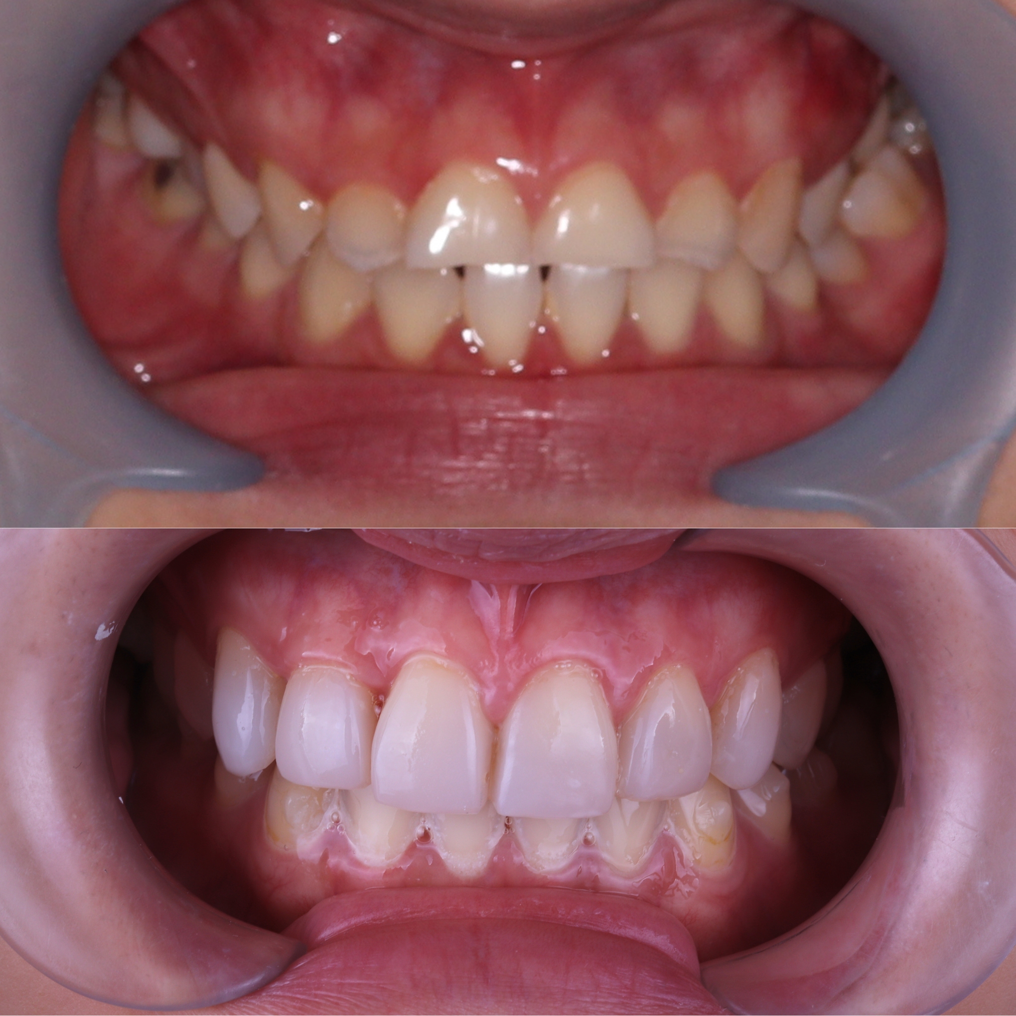 invisalign-plus