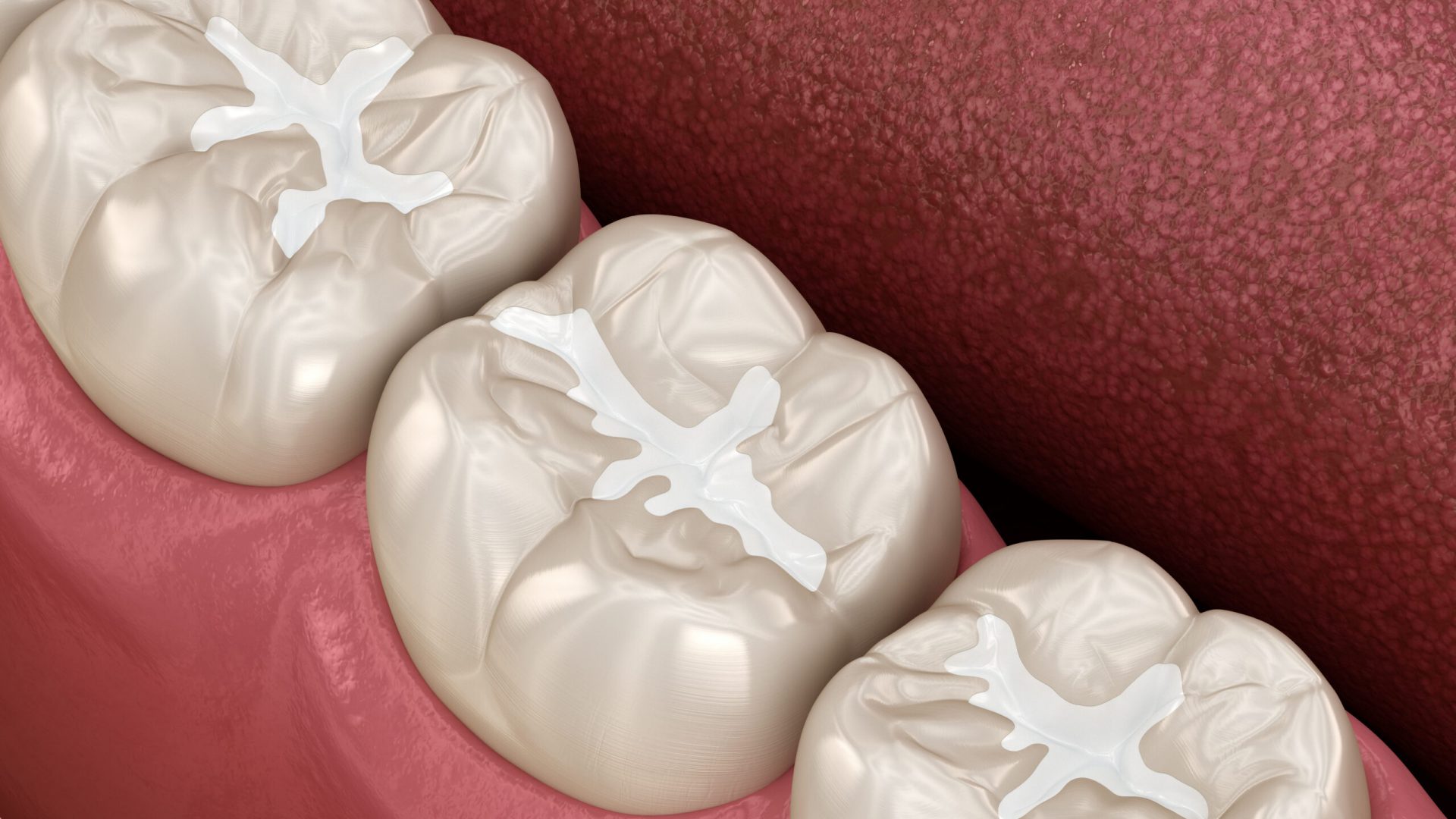 Molar Fissure dental fillings, Medically accurate 3D illustration of dental concept